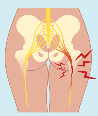 Sciatica Caulfield