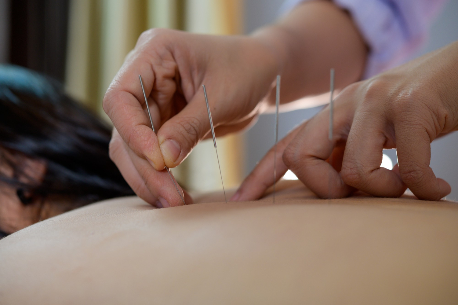 5 Common Questions About Dry Needling Treatment Answered